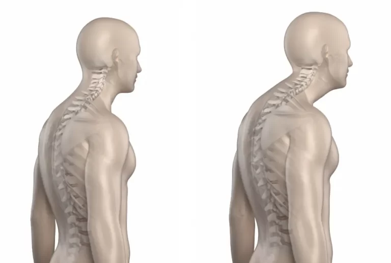 Kyphosis: Symptoms, Causes & Treatment Kyphosis: Symptoms, Causes & Treatment