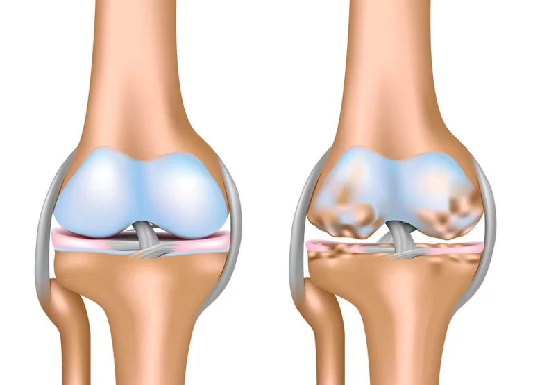 Osteoarthritis Surgery - Symptoms, Treatment & Cost Osteoarthritis Surgery - Symptoms, Treatment & Cost